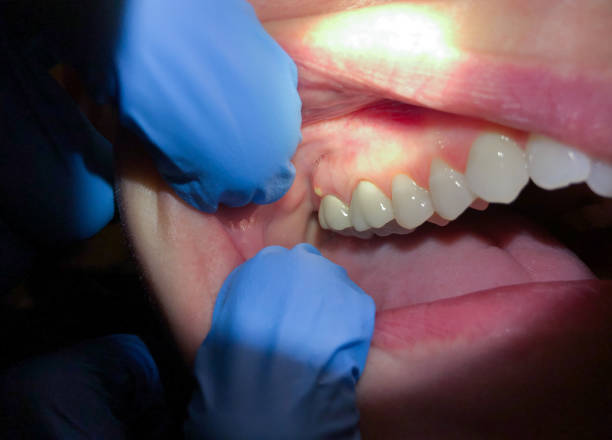 Best Emergency Treatment for Dental Infections or Abscesses in , AK